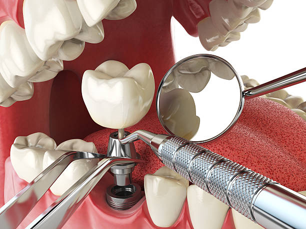 Best Broken or Chipped Tooth Repair in Lima, OH